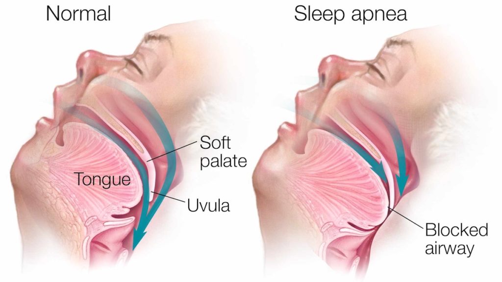 What Are The Main Causes Of Sleep Apnea? - Sleep Care Online